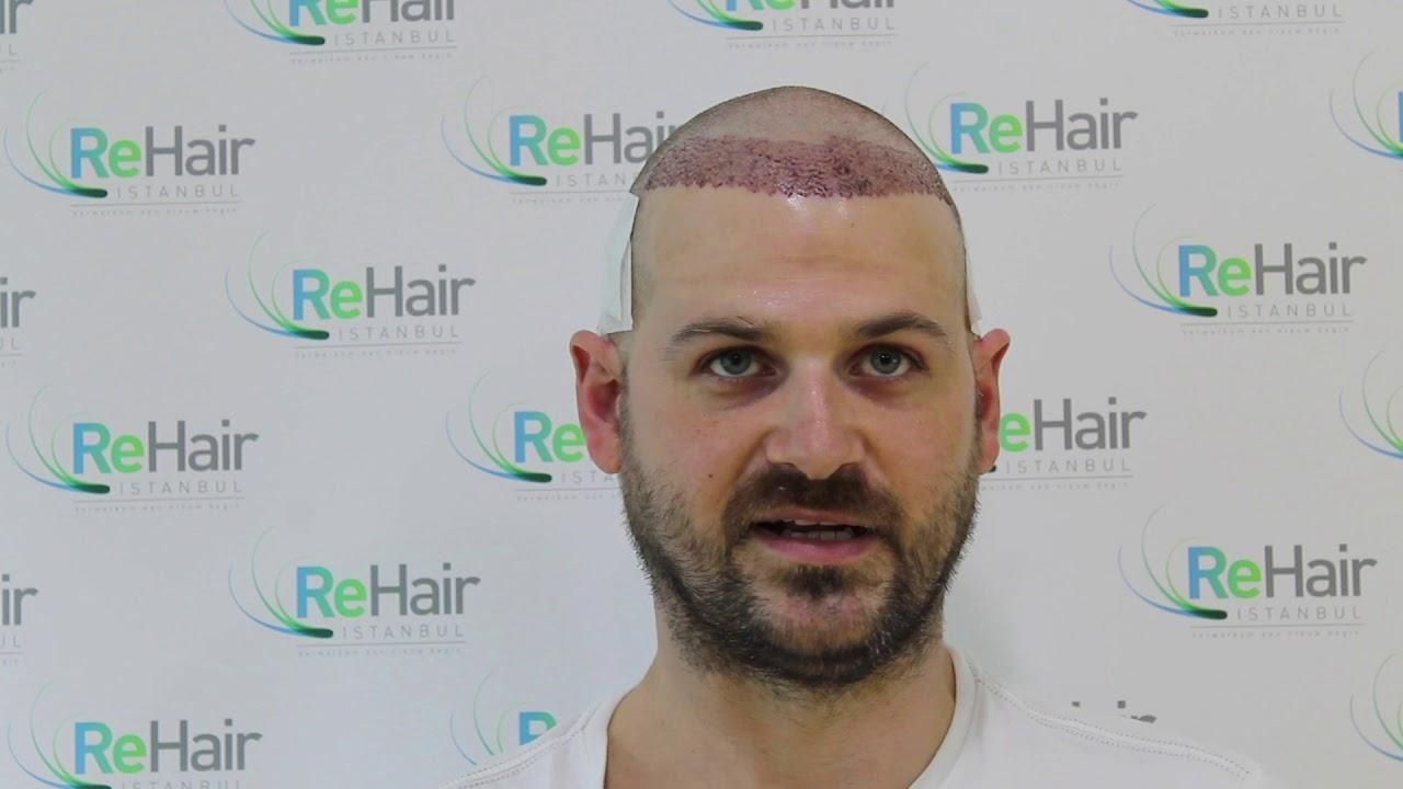 ReHair Istanbul - Review - Haartransplantatie in Istanbul, Turkije