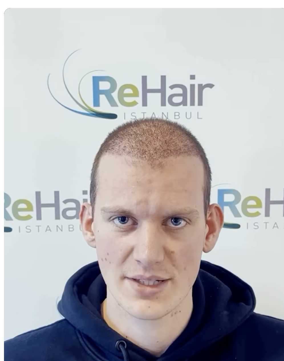 ReHair Istanbul - Review - Haartransplantatie Istanbul, Turkije