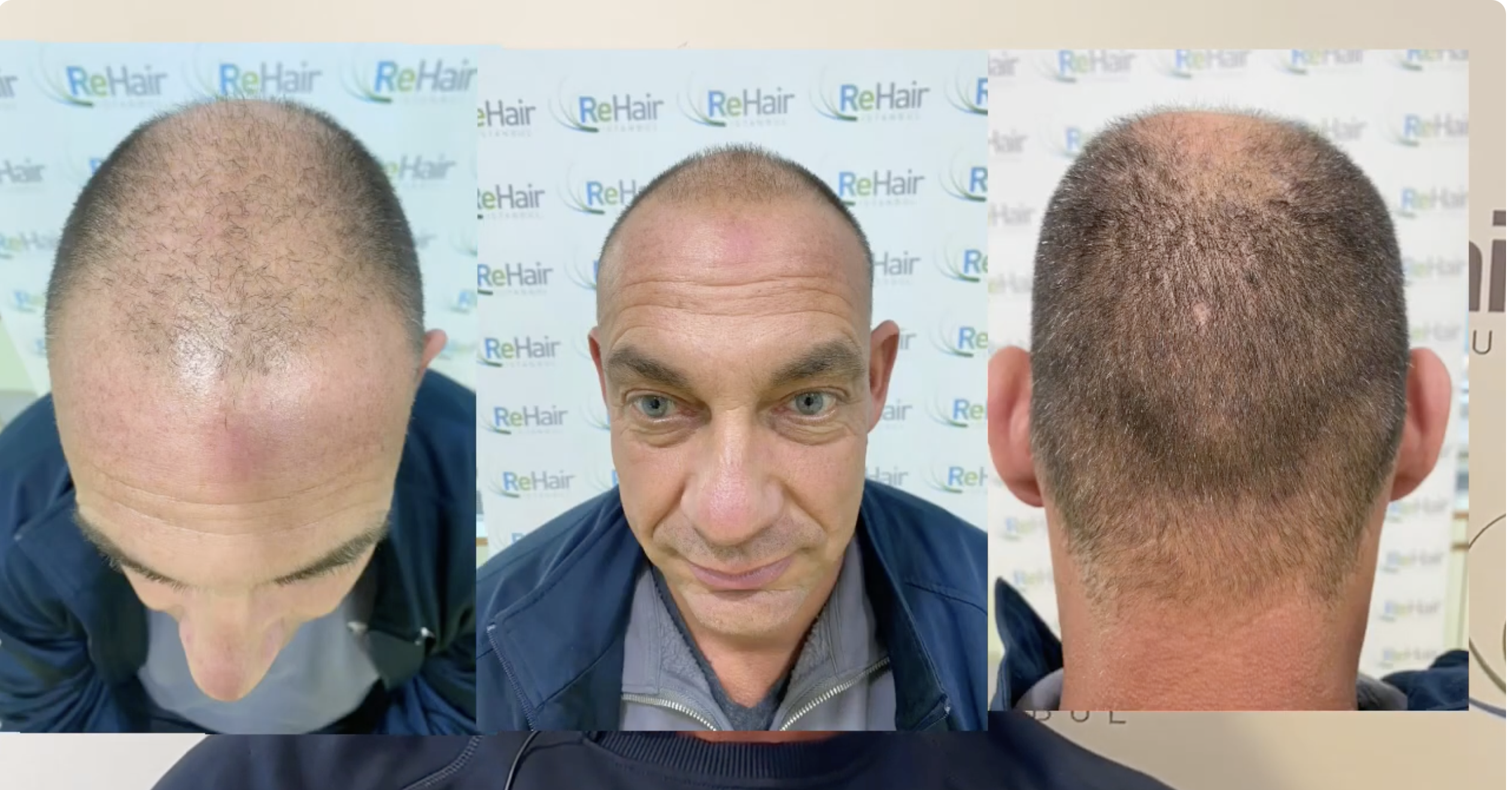ReHair Istanbul Review - Haartransplantatie Turkije, Istanbul