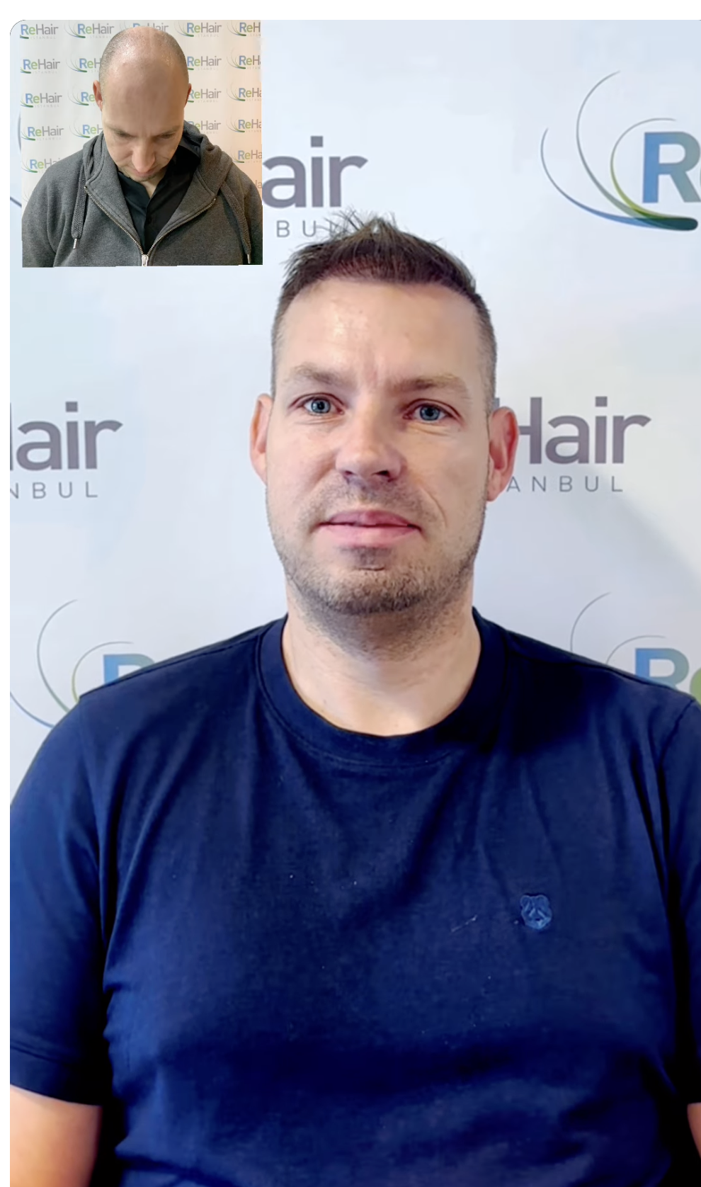 ReHair Istanbul Review - Haartransplantatie in Turkije, Istanbul