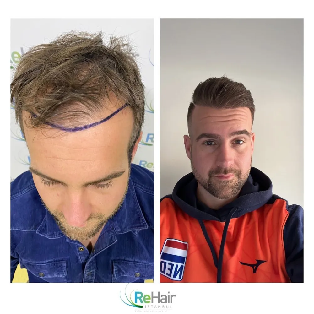 Voor & na · resultaat na 12 maanden